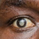Eye 690x450