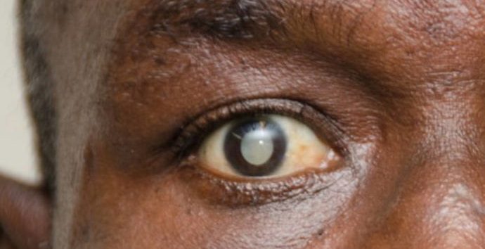 Eye